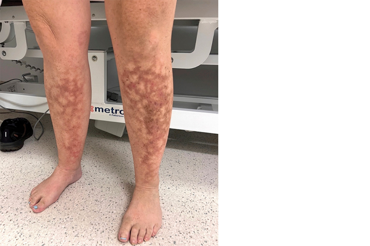 reticulated-hyperpigmentation-and-erythema-on-the-legs-medicine-today