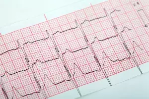 INOCA and MINOCA: coronary vasomotor disorders in clinical practice