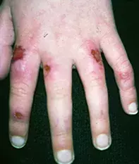 Fig 3. Chilblains