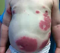 Fig. Palpable eruption Fig. Palpable eruption