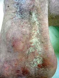 Fig. Atrophic skin.