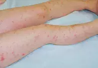 Figure 2. Folliculitis.