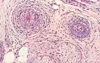 Fig 2. Lymphocytic inflammation