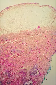 Fig 2. Skin biopsy Fig 2. Skin biopsy