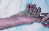 Fig 1. Blisters Fig 1. Blisters