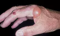 Fig 1. Acral blisters Fig 1. Acral blisters