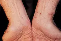 Fig 1. Excoriated lesions Fig 1. Excoriated lesions