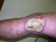 Fig 1. Leg ulcer Fig 1. Leg ulcer